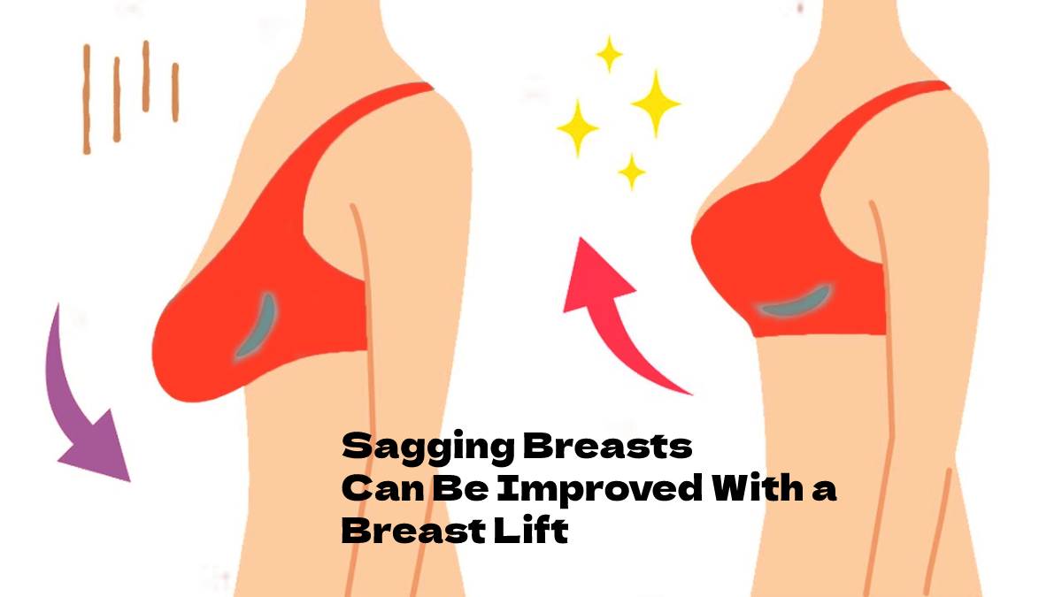 Sagging Breasts Can Be Improved With a Breast Lift