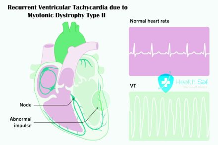 Recurrent Ventricular Tachycardia due to Myotonic Dystrophy Type II