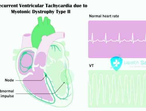 Recurrent Ventricular Tachycardia due to Myotonic Dystrophy Type II