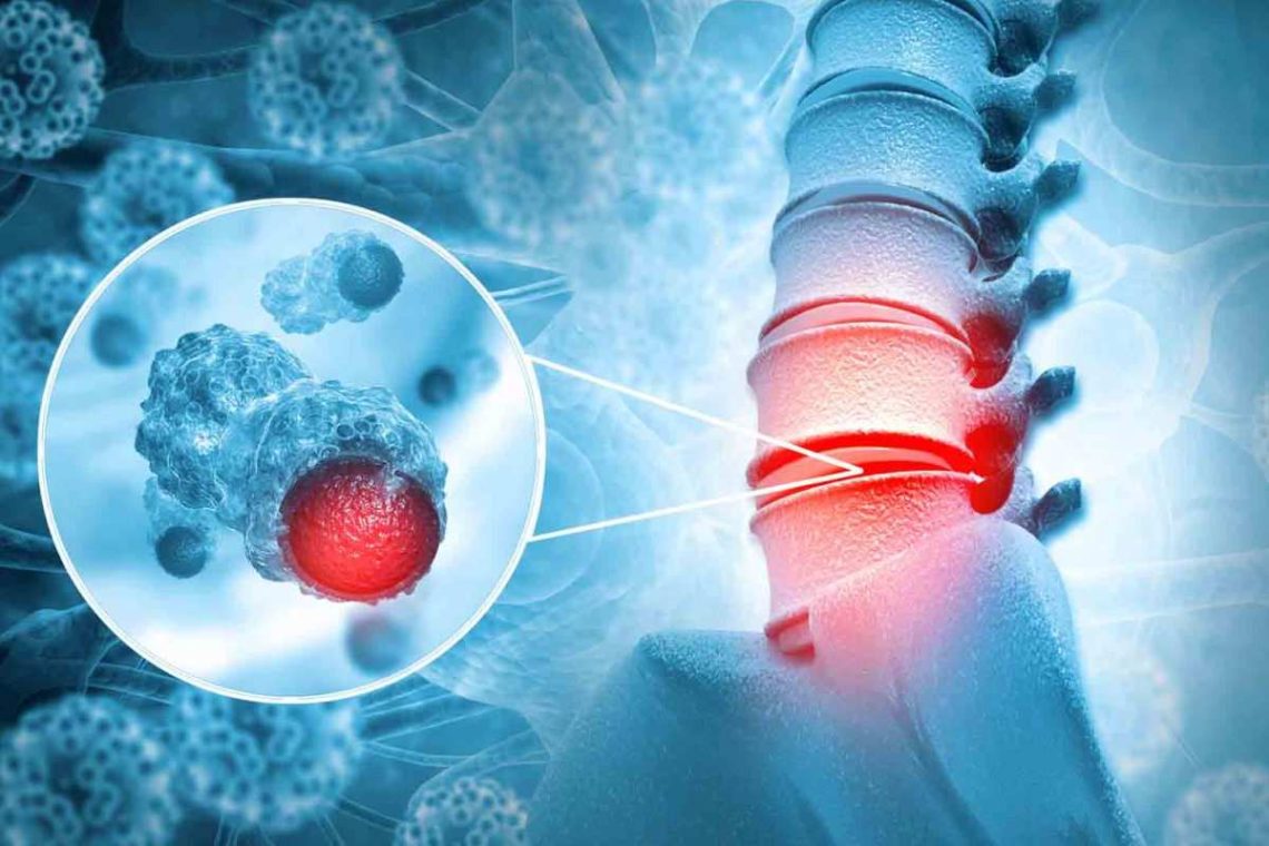 Spinal Tumors: Treatment Causes, And Symptoms