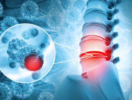 Spinal Tumors: Treatment Causes, And Symptoms