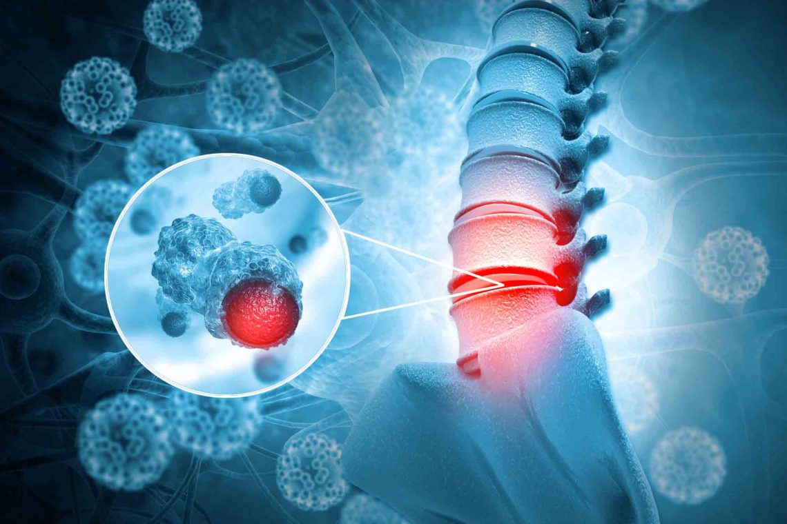 Spinal Tumors: Causes, Symptoms, And Treatment Options