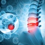 Spinal Tumors: Causes, Symptoms, And Treatment Options