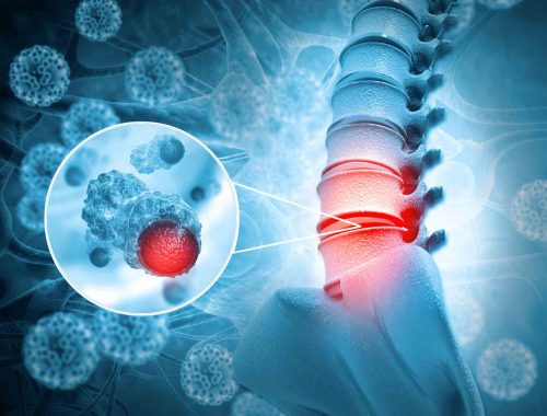 Spinal Tumors: Causes, Symptoms, And Treatment Options