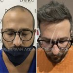 Dr. Serkan Aygin Pioneering Innovations in Hair Transplantation at Turkey's Elite Clinic (2)