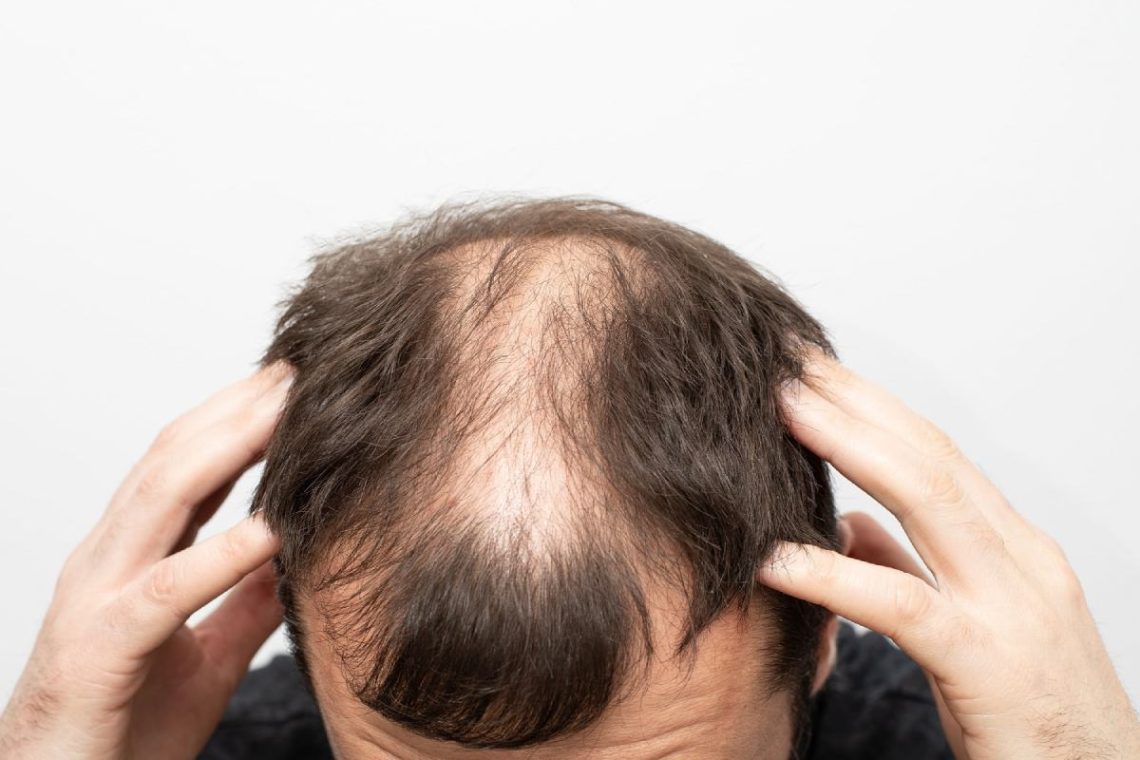 Male Pattern Baldness: Understanding, Coping, and Treatment Options