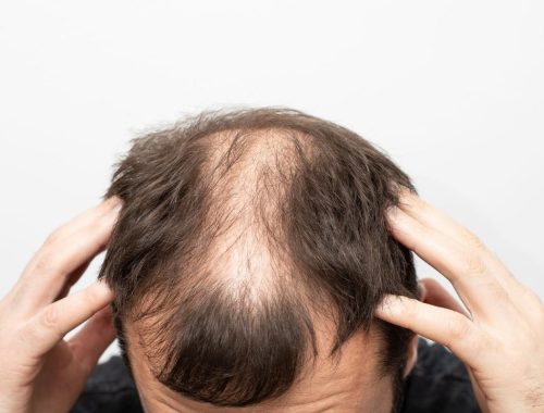 Male Pattern Baldness: Understanding, Coping, and Treatment Options