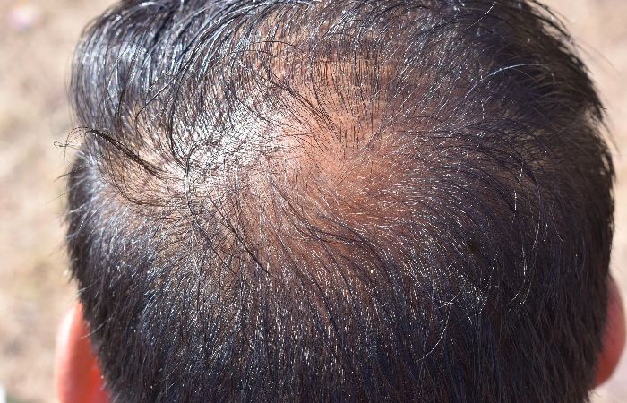 Recognizing the Signs of Male Pattern Baldness