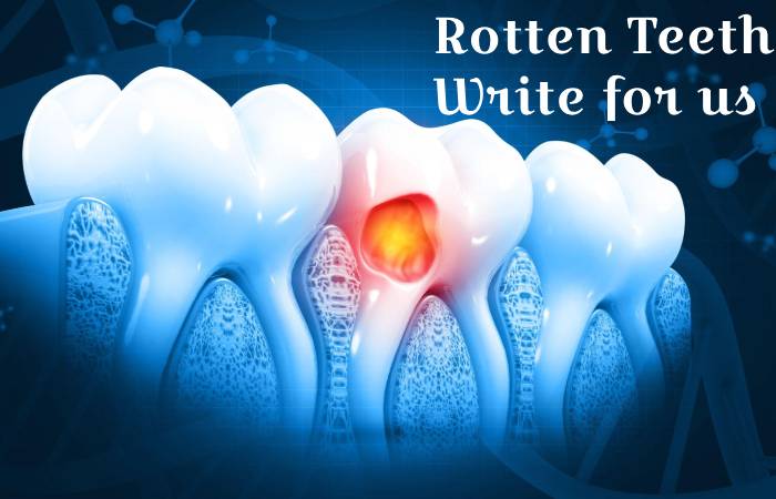 Rotten Teeth write for us