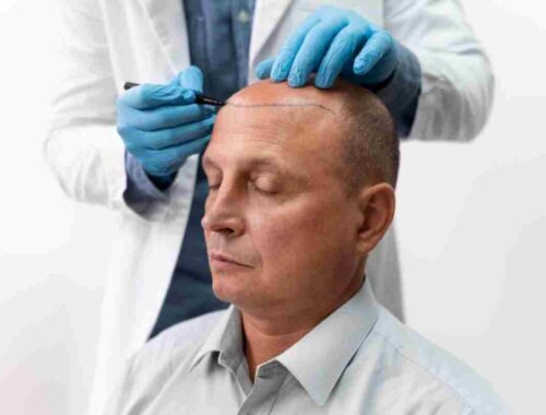 5 hair transplant secrets nobody will tell you