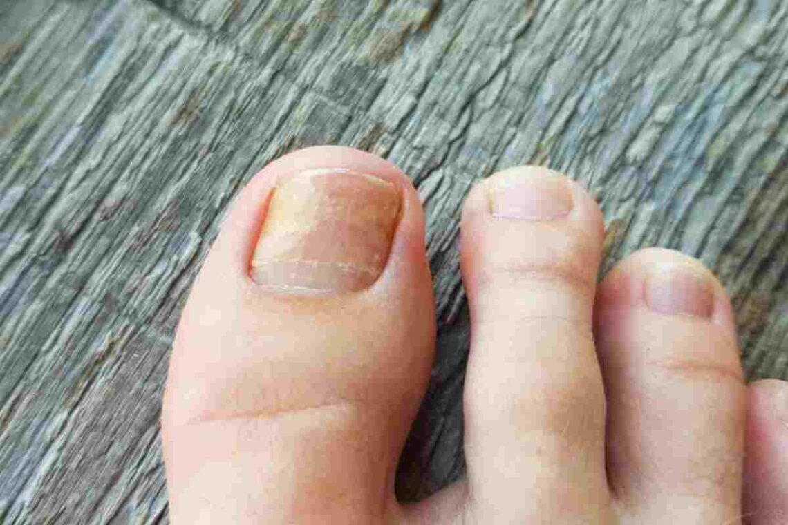 toenail fungus