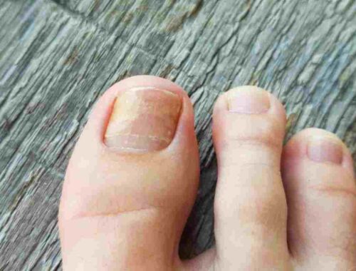 toenail fungus