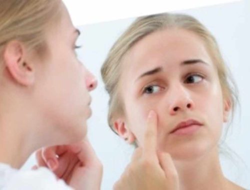 What is Body Dysmorphic Disorder