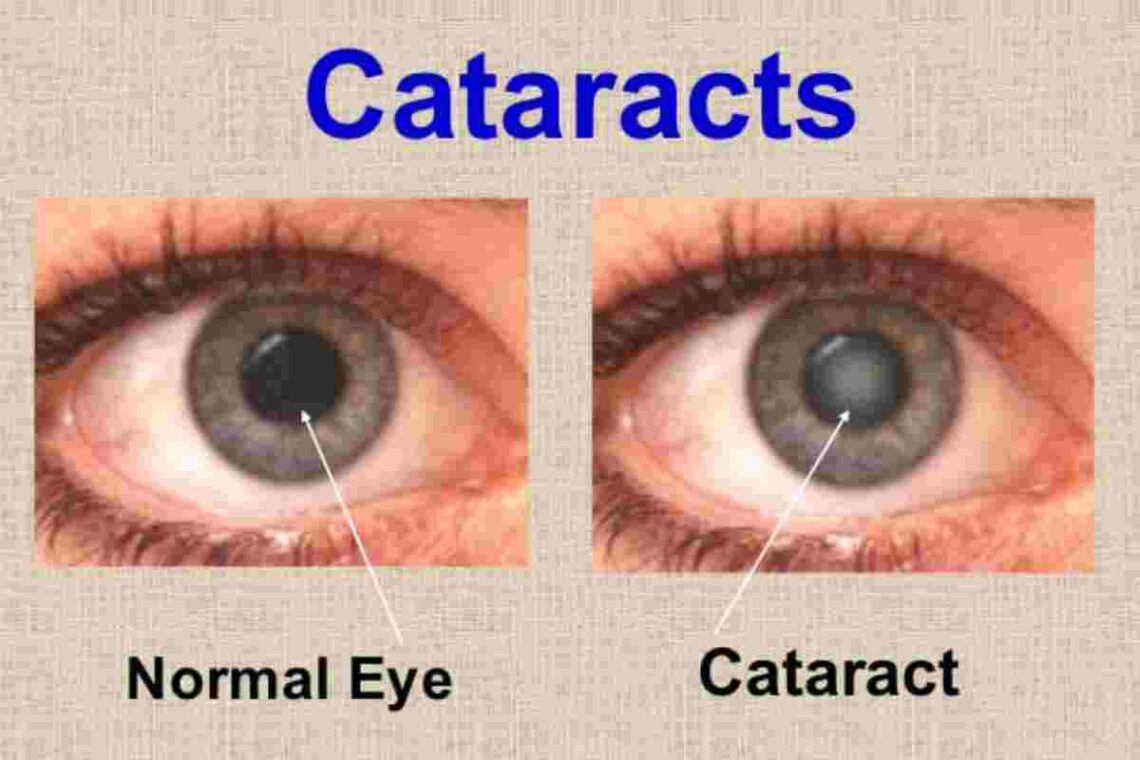 cataracts