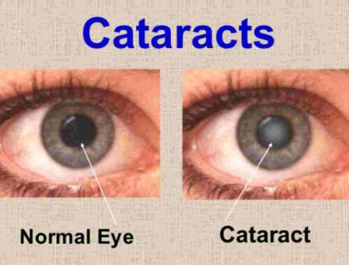 cataracts